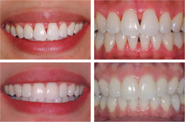 image of bioclear method before after