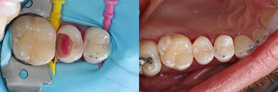 image of composite bonding course deep caries case study